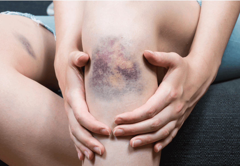 unusual-symptoms-of-ra-bruises-1