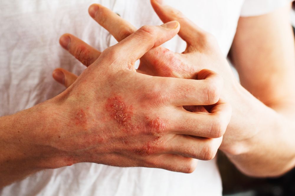 psoriasis-symptoms